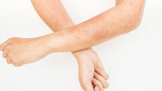 Does Stinging Nettle Leaf a Rash?