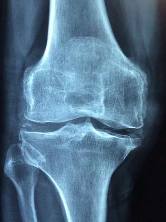 Stinging Nettle Root: The Natural Solution for Improving Joint Health and Reducing Inflammation