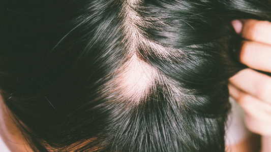 How Stinging Nettle Root Works for Hair Loss Prevention