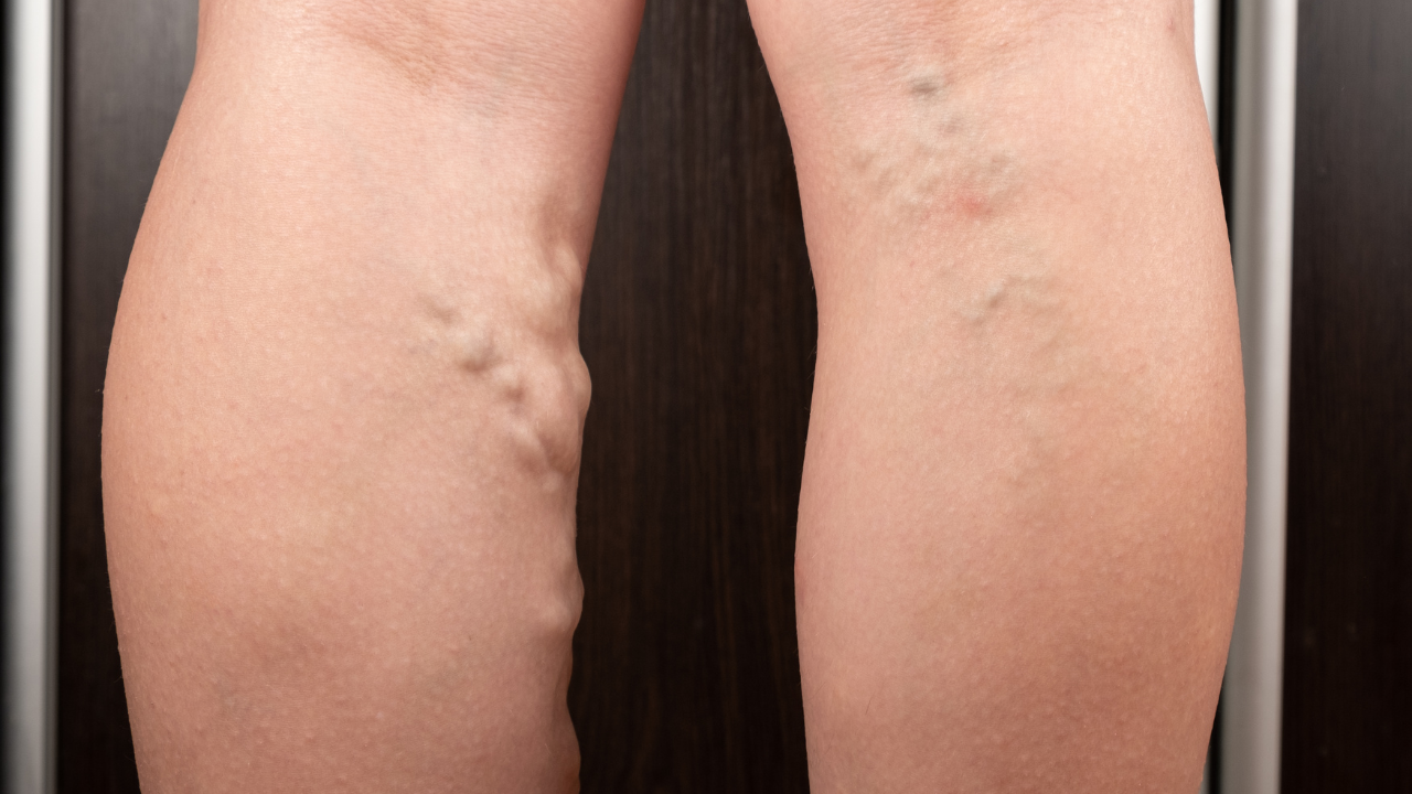 The Power of Pygeum Bark: Promising Anti-Thrombotic Effects – Real Herbs